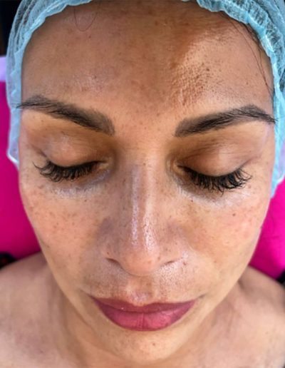 Limpieza Facial Profunda